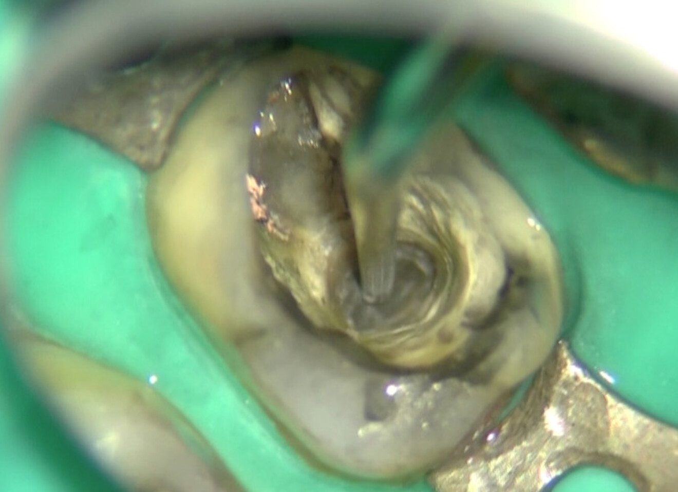 Fig. 11 : Tenon fibré progressivement éliminé dans la partie apicale à l’aide d’embouts ultrasoniques spéciaux.