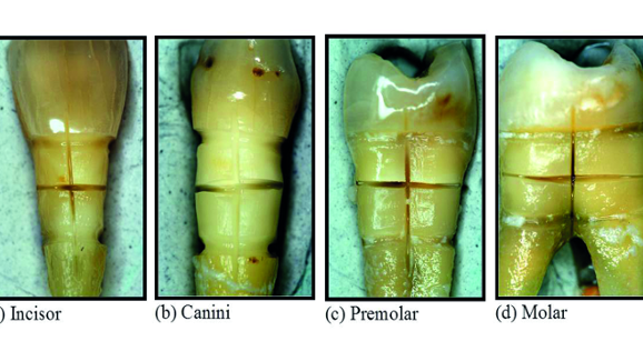 Modification of tooth neck dentin with a diode laser for desensitisation