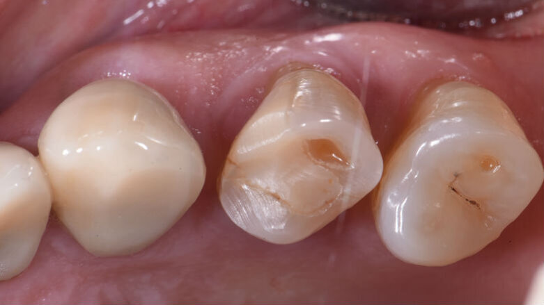 La customizzazione Cad-Cam delle cappette di guarigione negli impianti post-estrattivi