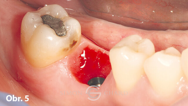 Formování měkkých tkání po dobu 3 týdnů