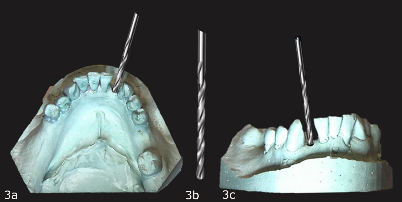 Figs. 3a–c: Pilot hole made in the cast at the planned implant site, paralleling it to the adjacent teeth and centring it in the site (a & c). Guide Right pilot drill (b).
