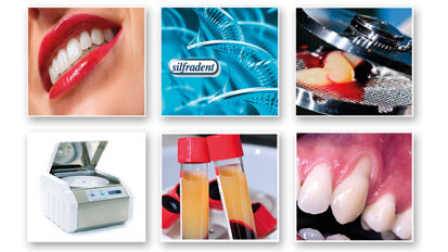 Concentrato di fattori di crescita  (Concentrated Growth Factors – CGF): un importante strumento nella medicina rigenerativa