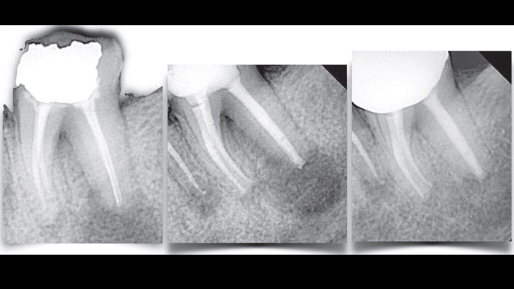 I ritrattamenti sono un modo unico per salvare non solo i denti ma anche l'osso circostante