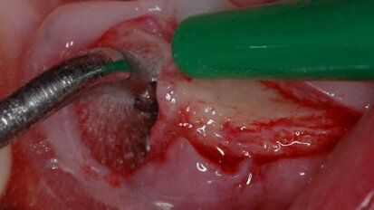 Chirurgia implantare minimamente invasiva nel paziente geriatrico a rischio