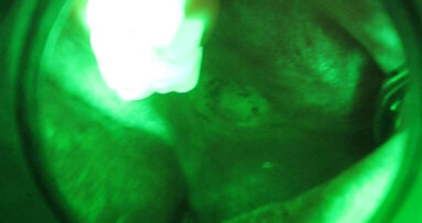 Lesione traumatica delle mucose orali in paziente con deficit mentali