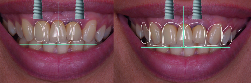 Fig. 4 : Conception numérique du sourire (DSD) des deux options de traitement.