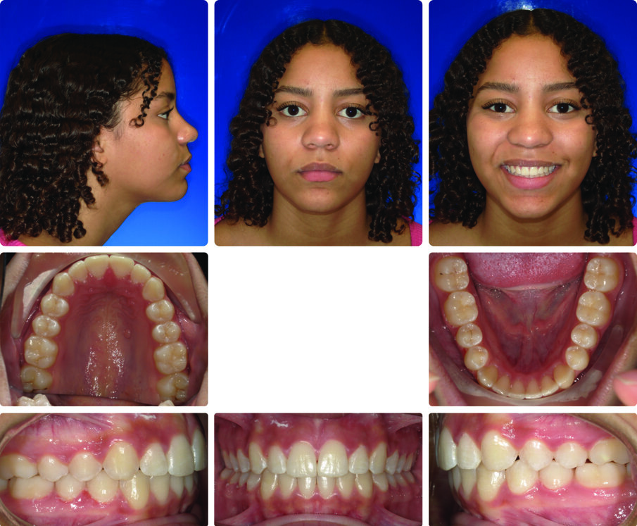 Fig. 4: Retention records obtained after an additional 10 aligners.