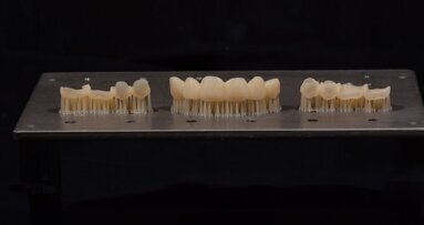 3D-printed provisional restorations for complex prosthetic rehabilitation: Full-mouth restoration of a severe case of erosion