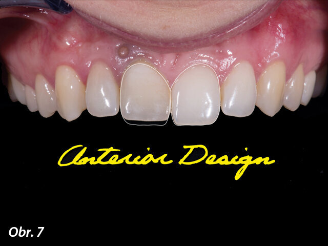 Návrh frontálních zubů.