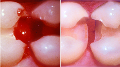 DT Study Club präsentiert Webinar zu Tissue Management DT Study Club präsentiert Webinar zu Tissue Management