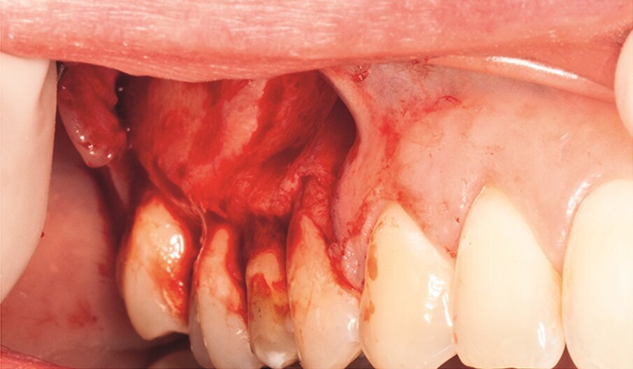 Fig. 2g: Full-thickness mucoperiosteal flap reflected.