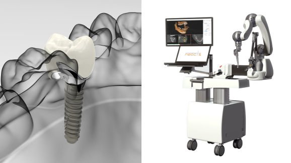 Un sistema robótico que podría cambiar la implantología