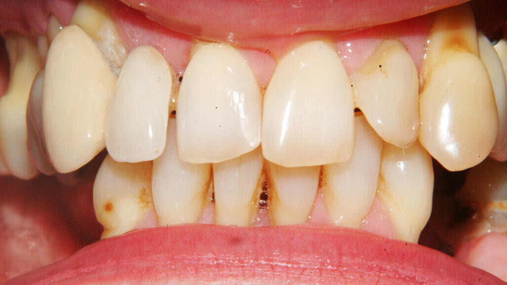 Periodontitis, Diabetes and Smoking