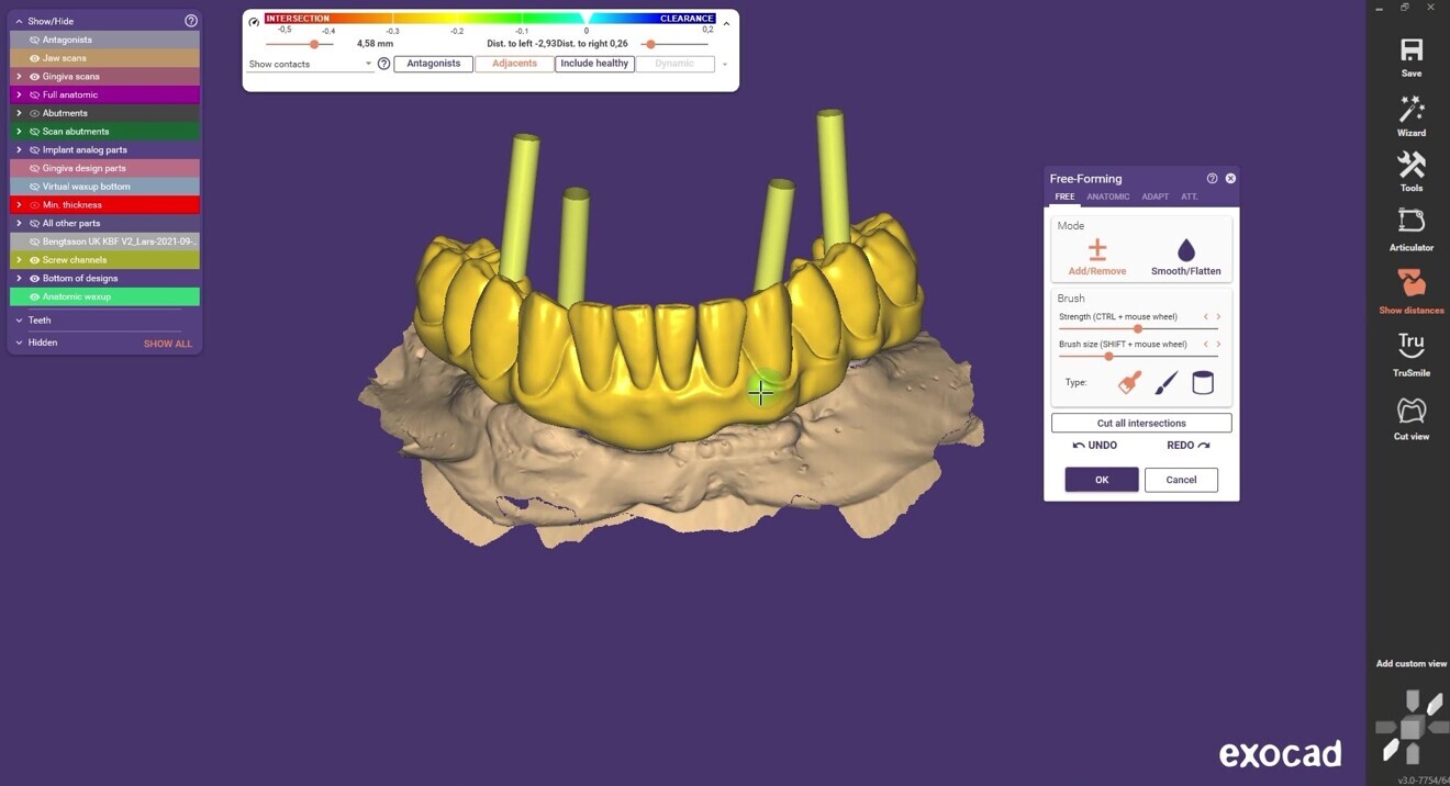 Fig. 13: CAD of the lower jaw prosthesis.