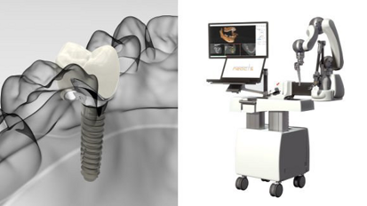 Un sistema robótico que podría cambiar la implantología Un sistema robótico que podría cambiar la implantología