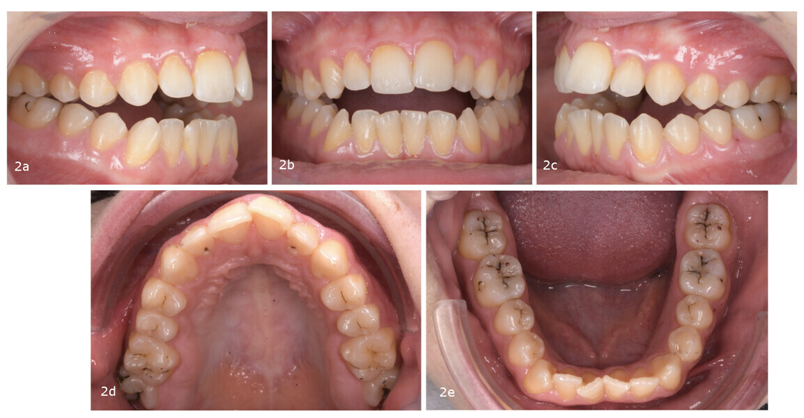 Figs. 2a–e: Pretreatment intra-oral photographs.