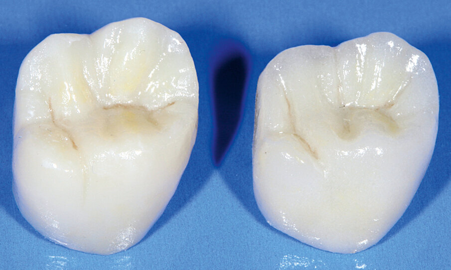 Fig. 2: Veneered and non-veneered MO restorations were evaluated and compared with each other in this case. Although IPS e.max CAD MO is typically a framework material, the differences between the two restorations are not at all that noticeable. 