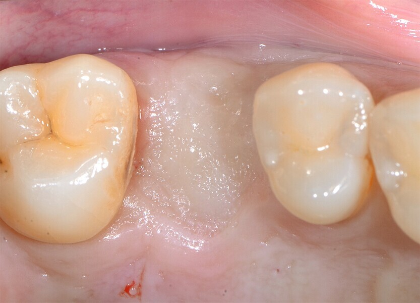 Fig. 5 : Cicatrisation de l’alvéole préservée.