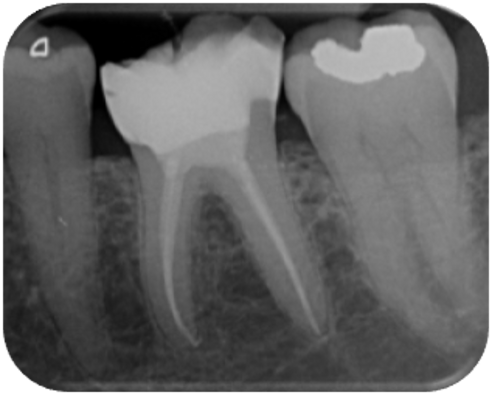 Fig. 16: Post-op radiograph showing the well-condensed obturation to within 2 mm of the radiographic apex and an adequate coronal seal provided by the composite restoration.