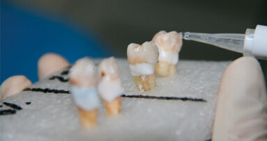 Valutazione in vitro della penetrazione di uno sbiancamento professionale