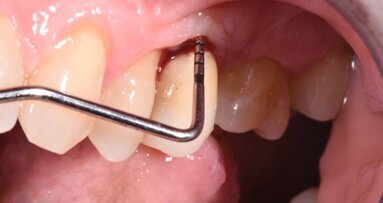 Trattamento non chirurgico della perimplantite. L’impiego di acido 5-aminolevulinico a supporto della TNC e il suo ruolo nella biostimolazione tissutale