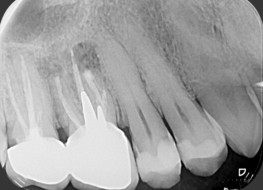 Fig. 1i - Radiografia postoperatoria.