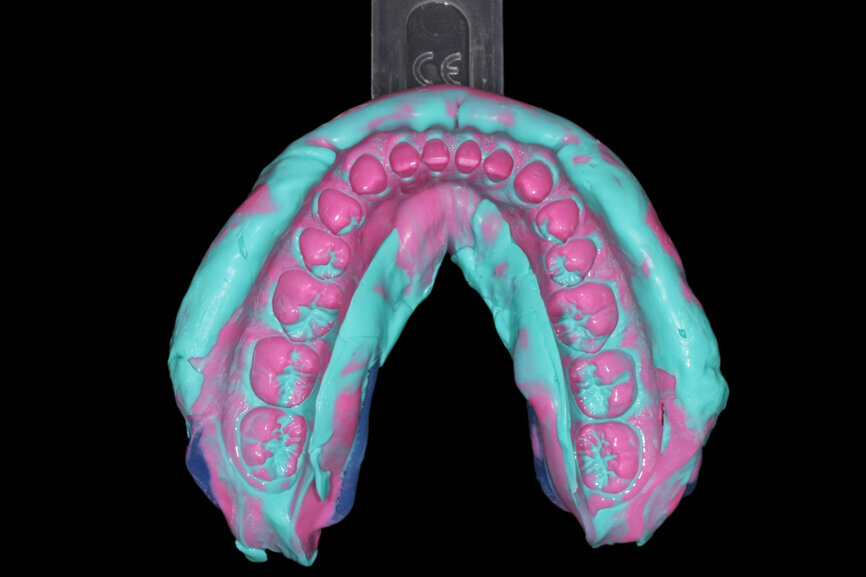 Fig. 16: Maxillary and mandibular impressions for the diagnostic models.