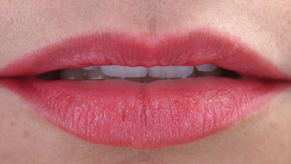 Fig. 17c. Labios en reposo, exposición de los bordes incisales.