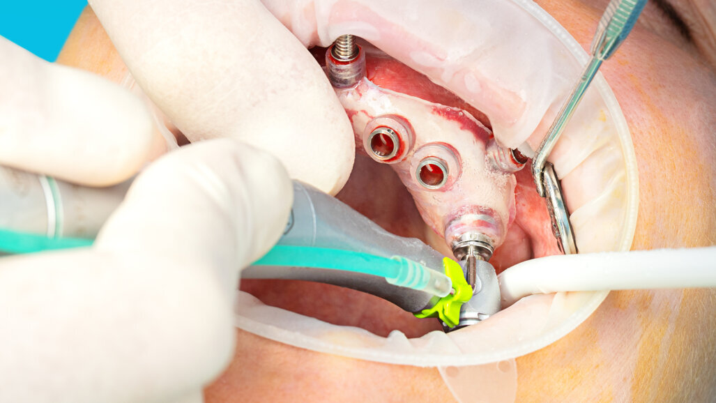 Redefining implant therapy with digital planning, guided placement and use of CONNECT abutments