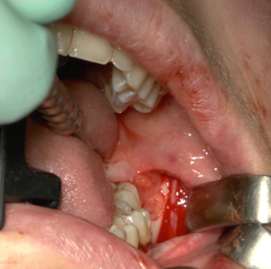 Fig. 12_Inserimento della membrana di PRP all’interno della cavità alveolare residua.