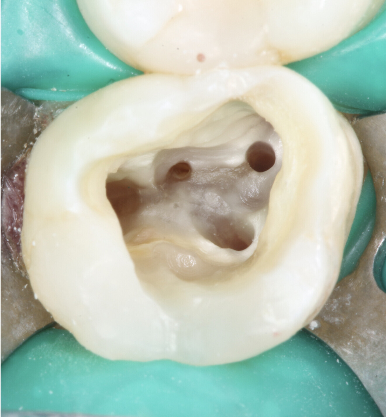 Fig. 4: Canal system shaped and cleaned before obturation.
