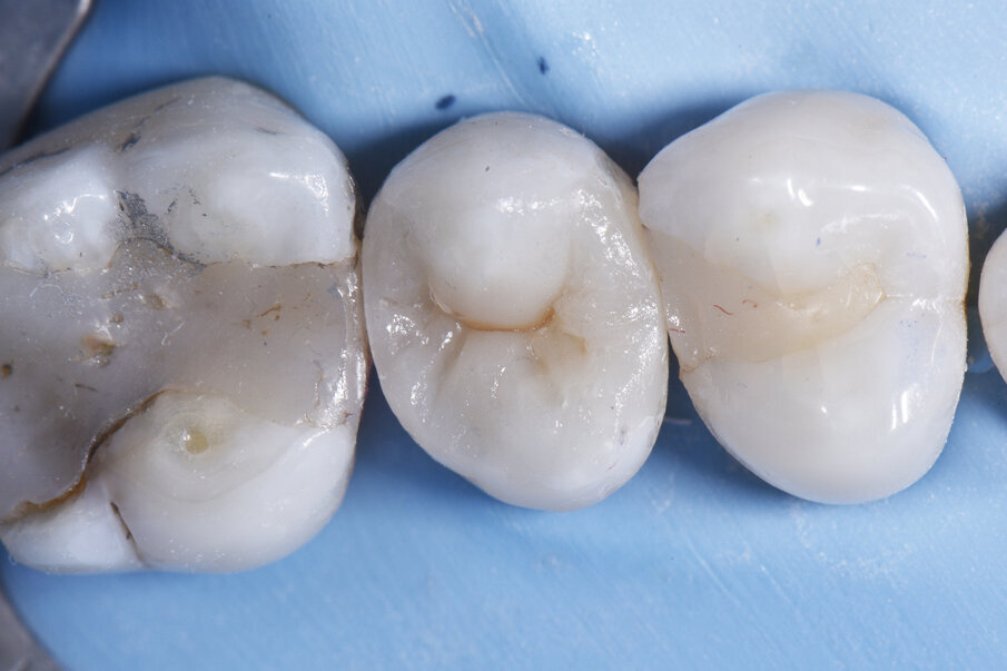 After - Final result after placement of lingual lobe and characterisation. This result demonstrates the superb handling, sculptability and chameleon effect of the universal, cloud-shaded ceram.x® SphereTEC™ one composite featuring spherical fillers for ultimate control of placement. Note the precision of line angle and bucco-lingual embrasure formation with Palodent® V3.  