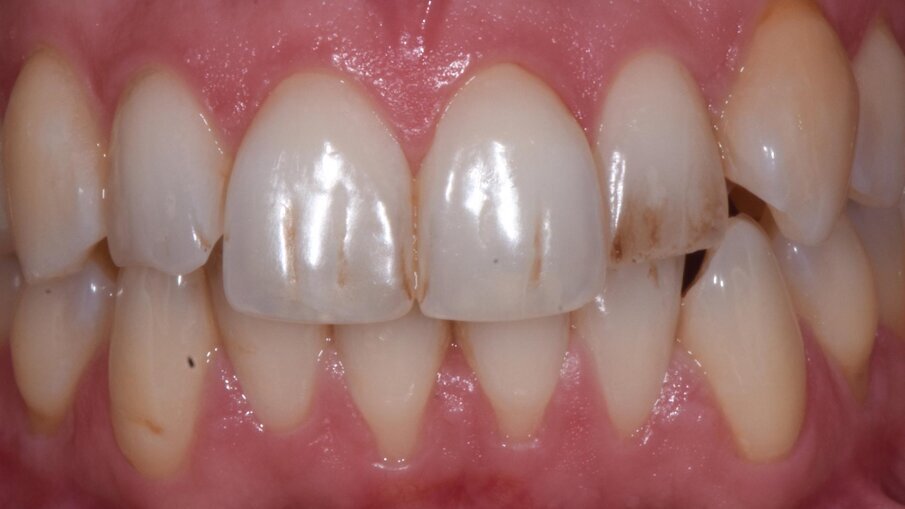 Figg. 1, 2 - Labbra incompetenti, si evidenziano i pigmenti nel sestante anteriore superiore.