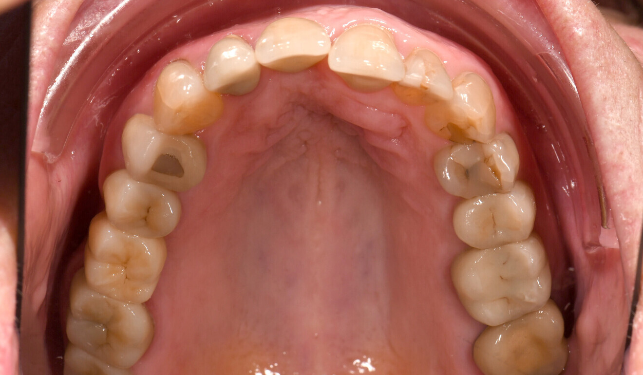Fig. 2: Initial situation, occlusal view of the maxilla.