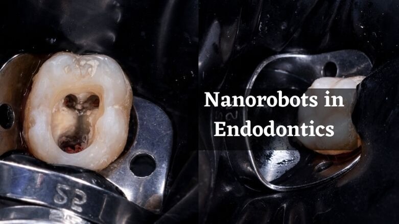 Nanorobots will prevent root canal treatment failures
