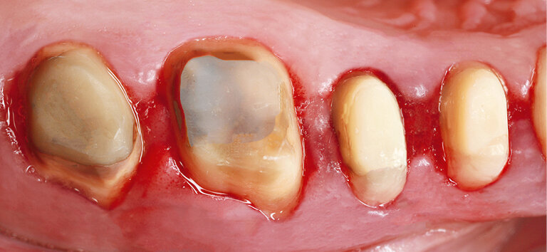Fig. 5: Preparation with the gums in critical conditions
