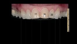 Afbeelding 5: Een digitale smile analyse werd uitgevoerd en een voorlopige planning werd gemaakt. De 21 en 11 moeten ongeveer 0,5 tot 0,75 mm worden verlengd.