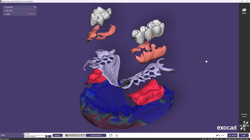 Exocad presenta PartialCAD 3.2 Elefsina para una mayor flexibilidad en el diseño de prótesis parciales