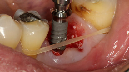 Straumann TLX: Immediate placement and loading in mandibular first molar position with follow-up Straumann TLX: Immediate placement and loading in mandibular first molar position with follow-up