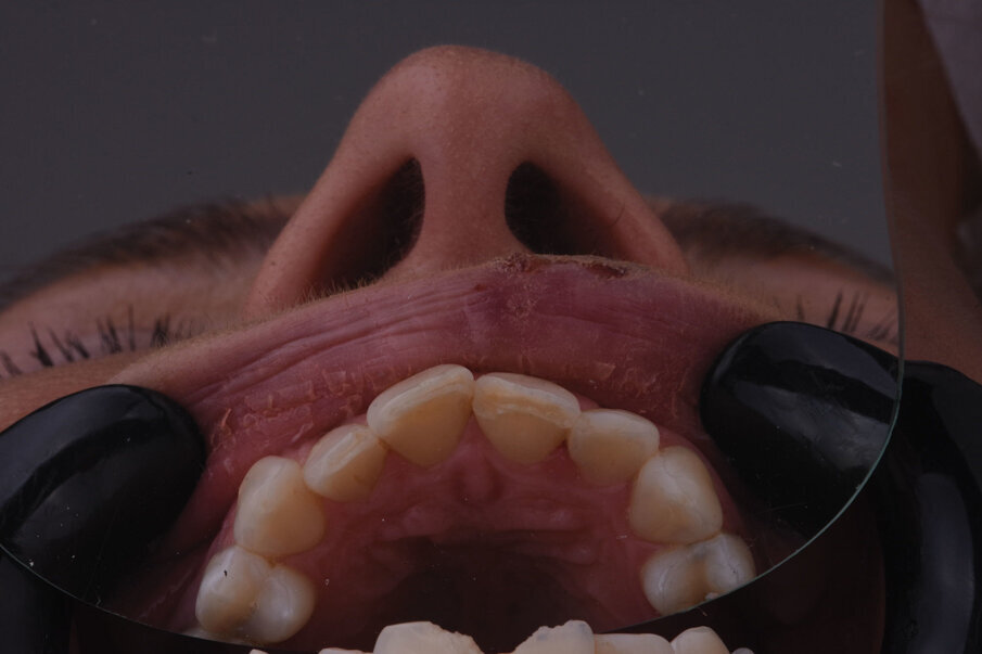 Sl. 3: Palatinalni prikaz frakturne linije