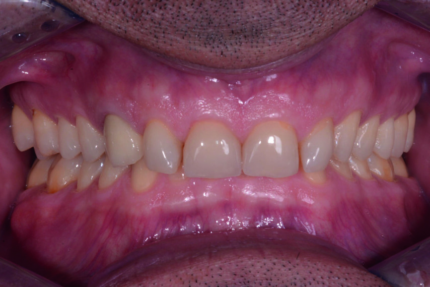 Fig. 7 : Deux ans plus tard, avant le traitement (2017). 