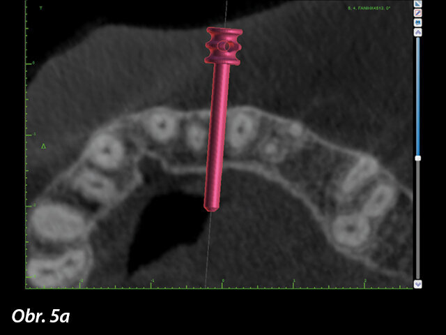 Kotevní piny jsou pečlivě umístěny tak, aby se vyhnuly blízkým vitálním strukturám a zároveň zasahovaly do kortikální kosti, což umožní získat bikortikální stabilitu všude tam, kde je to možné. Často penetrují jak bukální, tak lingvální lamely a zároveň se vyhýbají přiblížení k receptorovým oblastem pro implantáty.