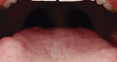 Guía Clínica para la atención odontológica del paciente con cáncer oral (4)