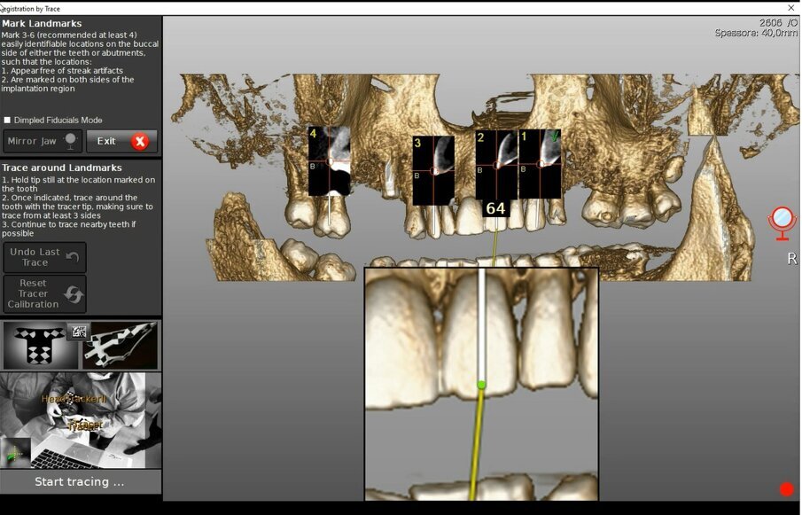 Figg. 6a-6d - Tracciatura della superficie di riferimento in tempo reale. a) Calibrazione del tastatore; b) Selezione dei denti e dei punti di partenza della scansione per tastatura; c) Fasi di scansione (tracer registration); d) Dettaglio clinico della procedura di tracer registration.