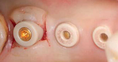 Piliers CAD/CAM individualisés sur implants en céramique