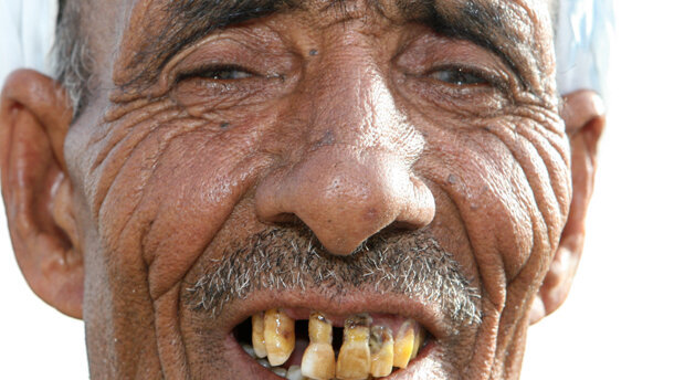 Ontbrekende tanden grootste afknapper