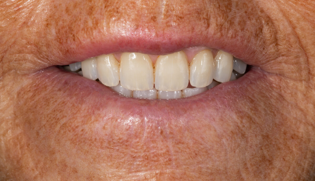 Fig. 15a: Extra-oral frontal of the final result.
