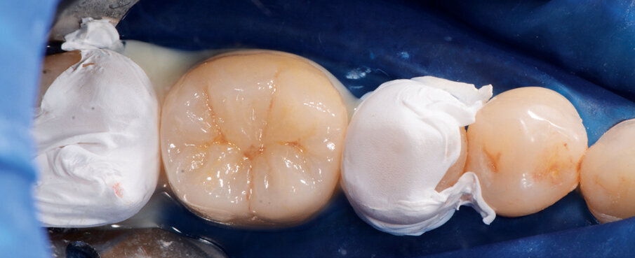 Fig. 8: Placing the crown.