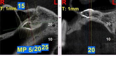 Detección y extracción de diente supernumerario
