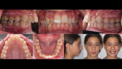 Trattamento di una seconda classe scheletrica con l’uso di resine fotopolimerizzabili